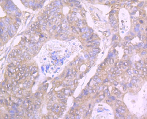 Immunohistochemical analysis of paraffin-embedded human colon cancer tissue using anti-GIT1 antibody