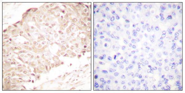 Immunohistochemistry analysis of paraffin-embedded human breast carcinoma tissue, using SENP1 Antibody