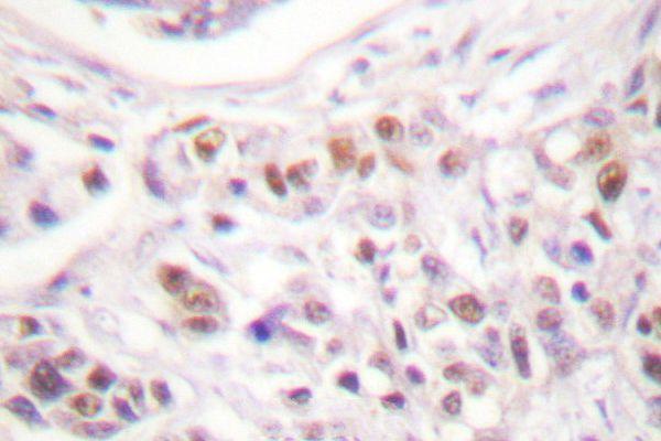 Immunohistochemistry (IHC) analyzes of Rad17 (A639) pAb in paraffin-embedded human breast carcinoma tissue
