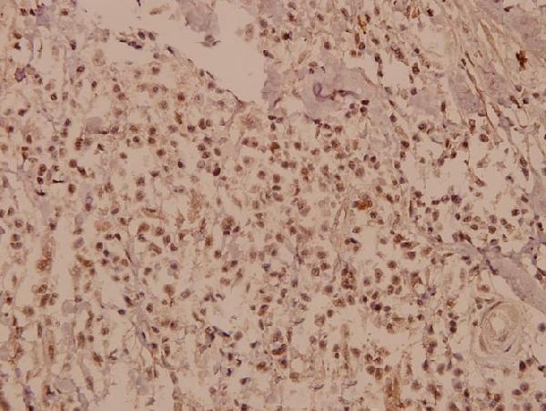 Immunohistochemistry (IHC) analyzes of CUG-BP1/2 (K95) pAb in paraffin-embedded human breast carcinoma tissue at 1:50