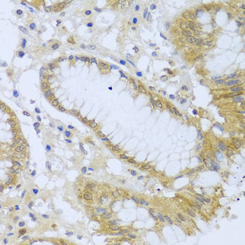 Immunohistochemistry of paraffin-embedded human liver damage using ACP1 antibody  at dilution of 1:100 