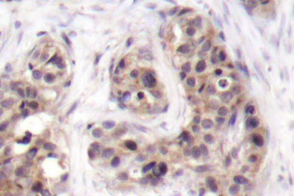 Immunohistochemistry (IHC) analyzes of G3BP-1 (D226) pAb in paraffin-embedded human lymphoma tissue