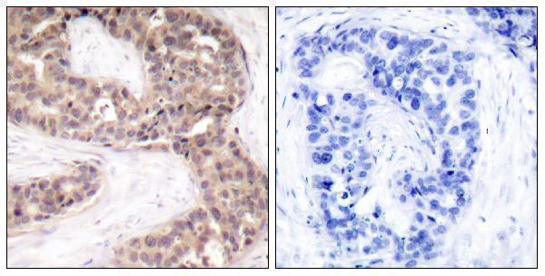 Immunohistochemistry analysis of paraffin-embedded human breast carcinoma tissue, using G3BP-1 Antibody