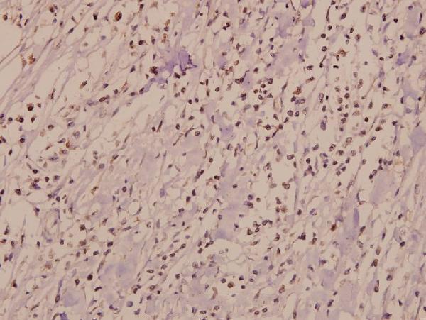 Immunohistochemistry (IHC) analyzes of IL-3Rβ (F587) pAb in paraffin-embedded human breast carcinoma tissue at 1:50