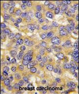 Formalin-fixed and paraffin-embedded human breast carcinoma tissue reacted with DKK3 Antibody (N-term), which was peroxidase-conjugated to the secondary antibody, followed by DAB staining