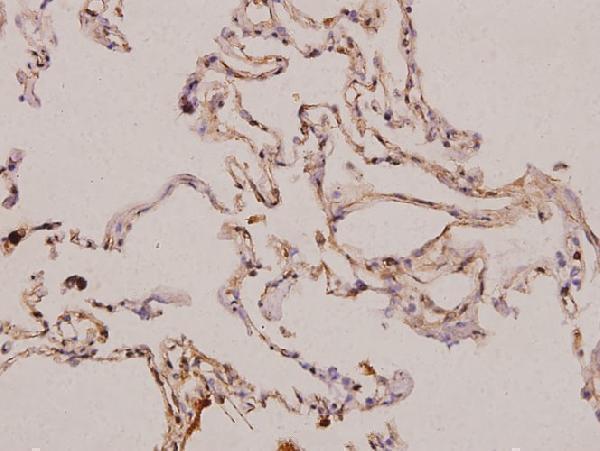 Immunohistochemistry (IHC) analyzes of PDGF-A (K154) pAb in paraffin-embedded human lung carcinoma tissue at 1:100