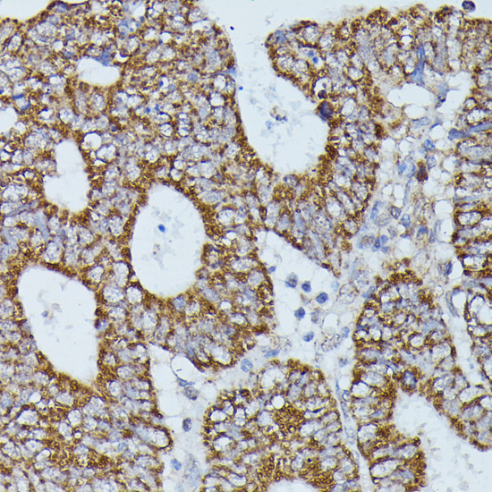 Immunohistochemistry of paraffin-embedded human colon carcinoma using FLII antibody  at dilution of 1:100 
