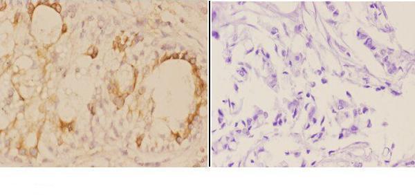 Immunohistochemistry (IHC) analyzes of ADAM12 pAb in paraffin-embedded human breast carcinoma tissue at 1:50,showing cytoplasmic,membrane and nuclear staining