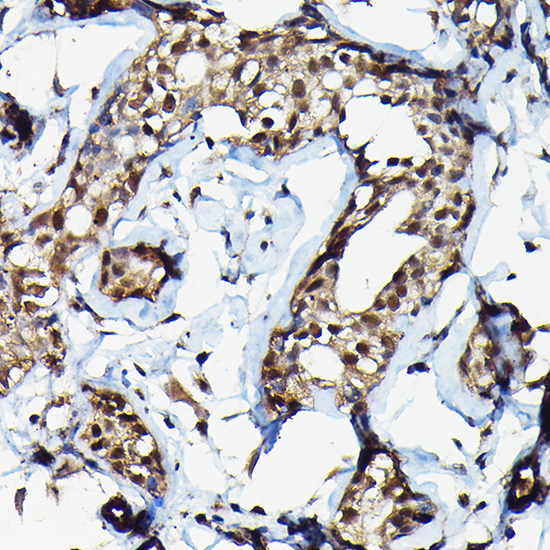 Immunohistochemistry analysis of paraffin-embedded human breast cancer using SUFU pAb at dilution of 1:100 (40x lens)