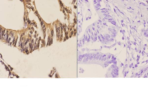 Immunohistochemistry (IHC) analyzes of Sp2 (D512) pAb in paraffin-embedded human colon carcinoma tissue at 1:50