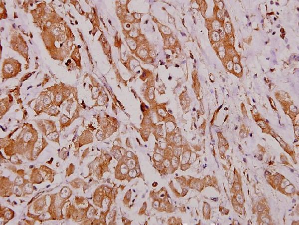 Immunohistochemistry (IHC) analyzes of Hexb (S516) pAb in paraffin-embedded human breast carcinoma tissue at 1:100