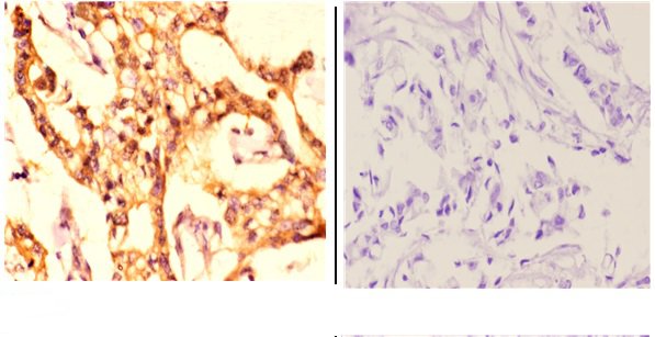 Immunohistochemistry (IHC) analyzes of MCM4 (P50) pAb in paraffin-embedded human breast carcinoma tissue at 1:50