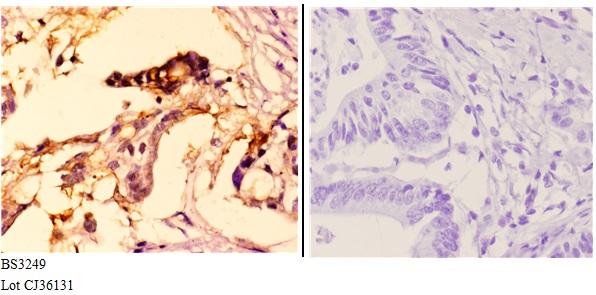 Immunohistochemistry (IHC) analyzes of MCM4 (P50) pAb in paraffin-embedded human colon carcinoma tissue at 1:51