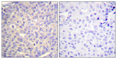Immunohistochemical analysis of paraffin-embedded Human breast cancer