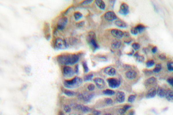 Immunohistochemistry (IHC) analyzes of Synaptotagmin (T196) pAb in paraffin-embedded human breast carcinoma tissue