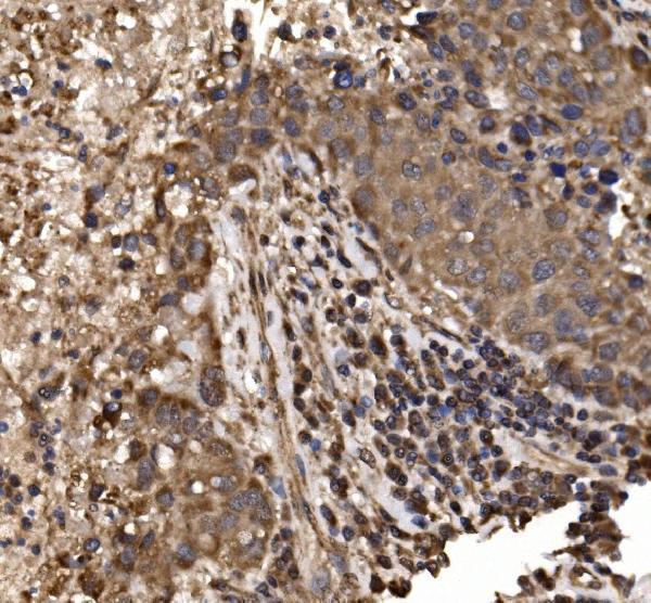  IHC analysis of delta 1 Catenin/CAS/CTNND1 using anti-delta 1 Catenin/CAS/CTNND1 antibody (A02333-3)