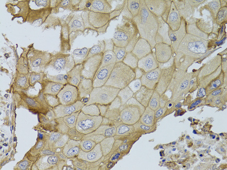 Immunohistochemistry of paraffin-embedded human breast cancer using GGT1 antibody  at dilution of 1:100 