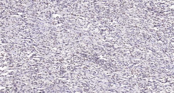 Immunohistochemical analysis of paraffin-embedded human Small intestinal stromal tumor