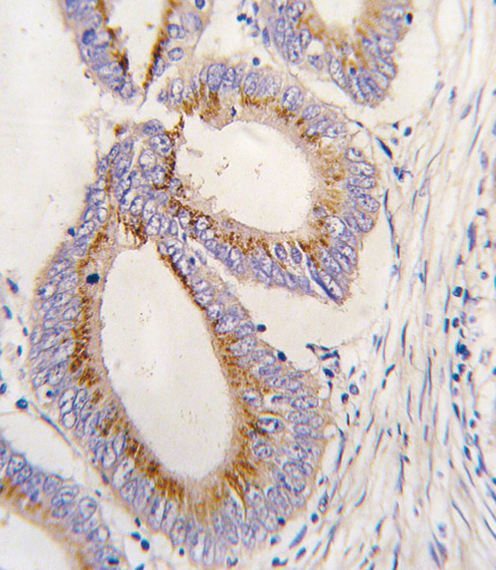 Formalin-fixed and paraffin-embedded human colon carcinoma tissue reacted with GDF11 antibody (N-term) , which was peroxidase-conjugated to the secondary antibody, followed by DAB staining