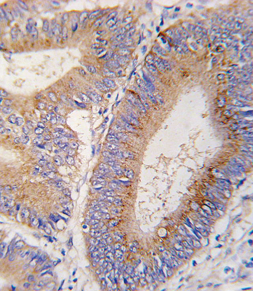 Formalin-fixed and paraffin-embedded human colon carcinoma tissue reacted with GDF11 antibody (N-term) , which was peroxidase-conjugated to the secondary antibody, followed by DAB staining