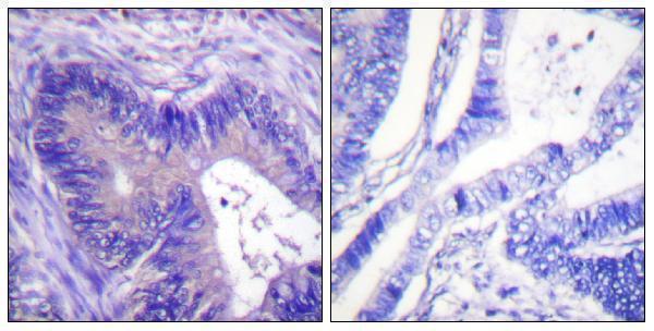 Immunohistochemistry analysis of paraffin-embedded human colon carcinoma, using ATP-Citrate Lyase (Phospho-Ser454) Antibody