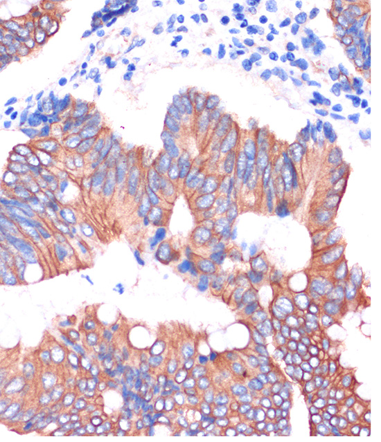 Immunohistochemistry of paraffin-embedded Human colon carcinoma using CGN Rabbit pAb  at dilution of 1:100 