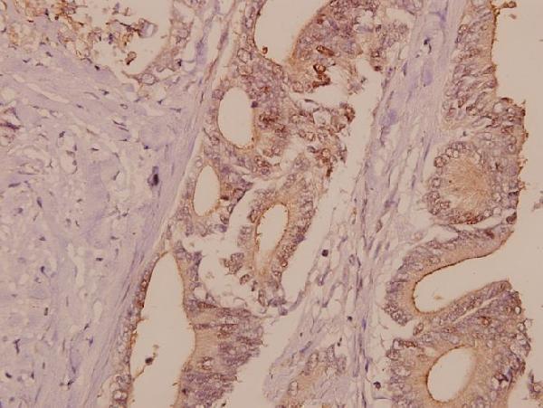 Immunohistochemistry (IHC) analyzes of DNA Ligase I (E139) pAb in paraffin-embedded human colorectal carcinoma tissue at 1:50
