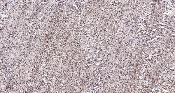 Immunohistochemical analysis of paraffin-embedded human Colon cancer