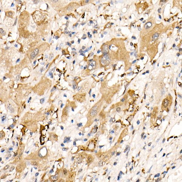 Immunohistochemistry of paraffin-embedded human liver cancer using Ferritin Heavy Chain Rabbit pAb  at dilution of 1:100 