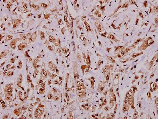 Immunohistochemistry (IHC) analyzes of APRIL (S183) pAb in paraffin-embedded human breast carcinoma tissue at 1:100