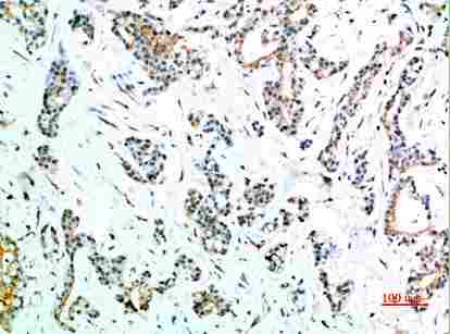 Immunohistochemical analysis of paraffin-embedded human-stomach-cancer, antibody was diluted at 1:200