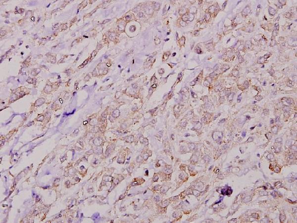 Immunohistochemistry (IHC) analyzes of COL4A2 (P175) pAb in paraffin-embedded human breast carcinoma tissue at 1:50