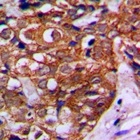 Immunohistochemistry of paraffin-embedded human breast cancer using MVK pAb at dilution of 1:50