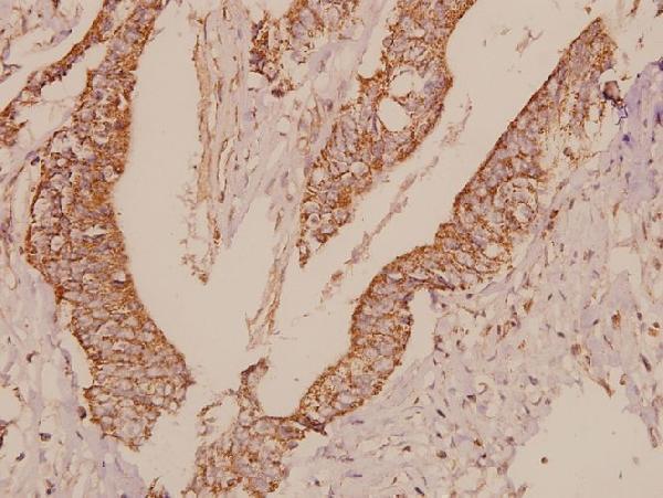 Immunohistochemistry (IHC) analyzes of TRF1 (L215) pAb in paraffin-embedded human colorectal carcinoma tissue at 1:50