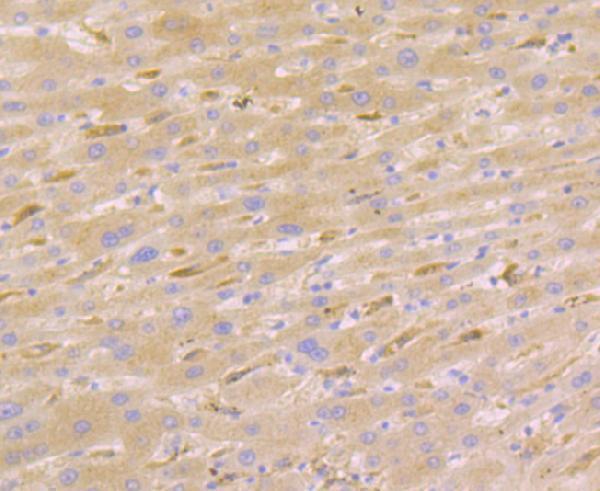 Immunohistochemical analysis of paraffin-embedded human liver cancer tissue using anti-Nudel antibody
