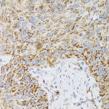 Immunohistochemistry of paraffin-embedded human lung cancer using PDYN antibody  at dilution of 1:100 