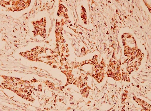 Immunohistochemistry (IHC) analyzes of GRP75 (S664) pAb in paraffin-embedded human breast carcinoma tissue at 1:100