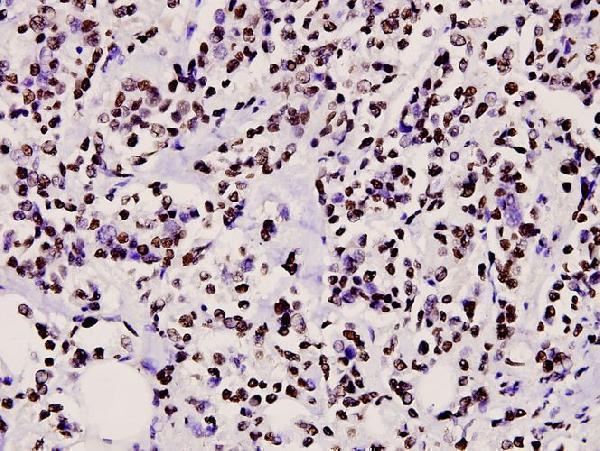 Immunohistochemistry (IHC) analyzes of CtBP2 (P432) pAb in paraffin-embedded human breast carcinoma tissue at 1:100