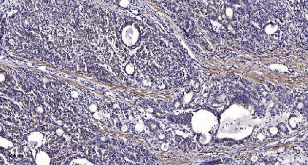 Immunohistochemical analysis of paraffin-embedded human Gastric adenocarcinoma