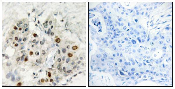 Immunohistochemistry analysis of paraffin-embedded human breast carcinoma tissue, using AF4 Antibody
