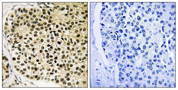 Immunohistochemistry analysis of paraffin-embedded human breast carcinoma, using NFAT3 (Phospho-Ser168+Ser170) Antibody