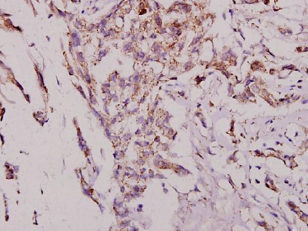Immunohistochemistry (IHC) analyzes of JNK1/2/3 (T178) pAb in paraffin-embedded human breast carcinoma tissue at 1:50