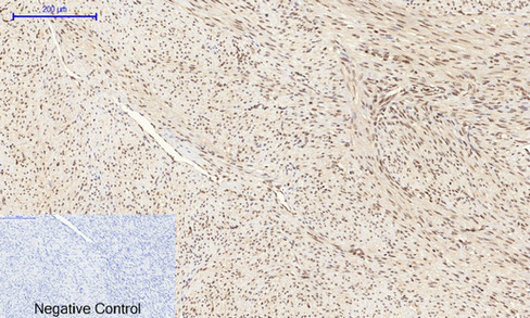 Immunohistochemical analysis of paraffin-embedded Human-uterus-cancer tissue