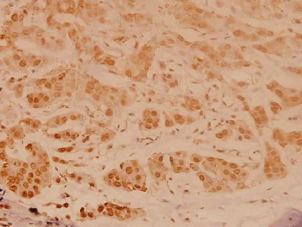 Immunohistochemistry (IHC) analyzes of JNK1/2/3 (Y185) pAb in paraffin-embedded human breast carcinoma tissue at 1:100