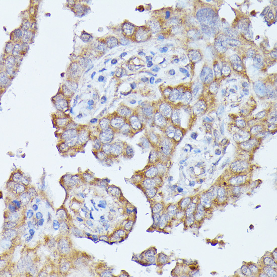 Immunohistochemistry of paraffin-embedded human lung cancer using HAL antibody  at dilution of 1:100 