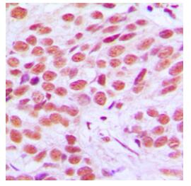 Immunohistochemical analysis of FOSL2 staining in human breast cancer formalin fixed paraffin embedded tissue section
