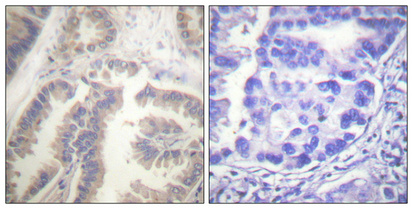 Immunohistochemical analysis of paraffin-embedded Human lung cancer