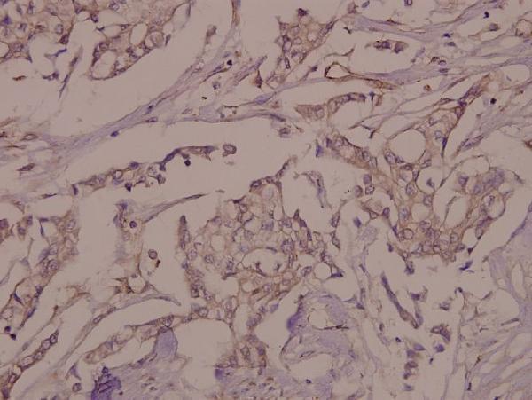 Immunohistochemistry (IHC) analyzes of p-VE-Cadherin (Y731) pAb in paraffin-embedded human breast carcinoma tissue at 1:50