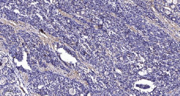 Immunohistochemical analysis of paraffin-embedded human Gastric adenocarcinoma