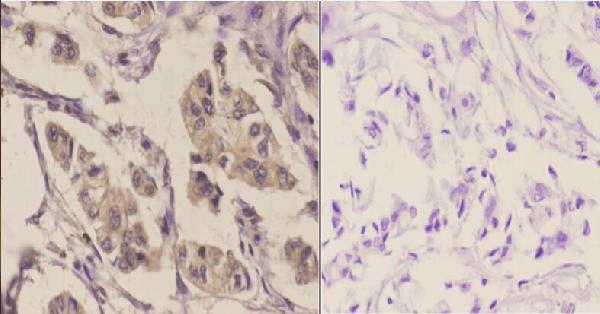Immunohistochemistry (IHC) analyzes of GluR1 (S857) pAb in paraffin-embedded human breast carcinoma tissue at 1:50